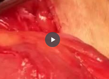 hyaregen vid2